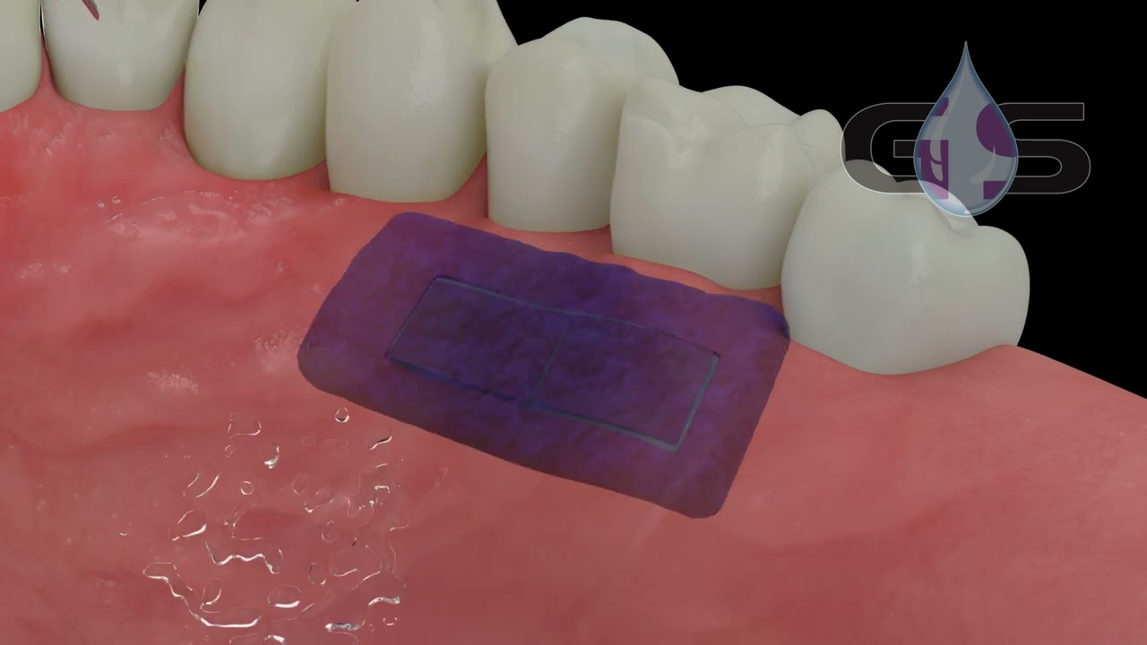 PeriAcryl tissue adhesive with Connective Tissue Graft (CTG)