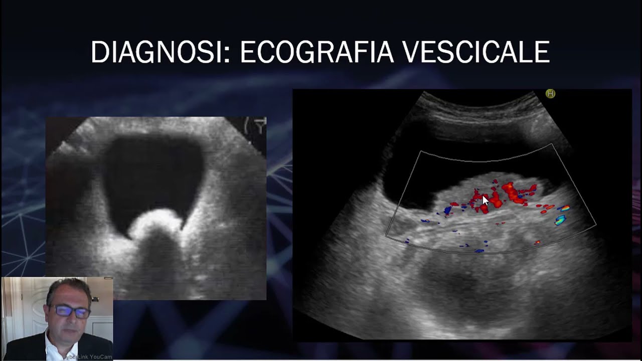 Tumori della vescica - Ecografia