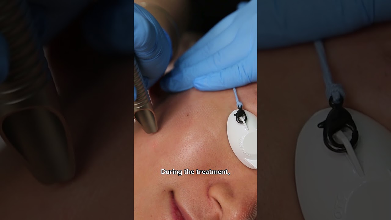 Skin Resurfacing Laser: Fotona Erbium Laser in Sydney | Large Pores and Skin Texture Treatment