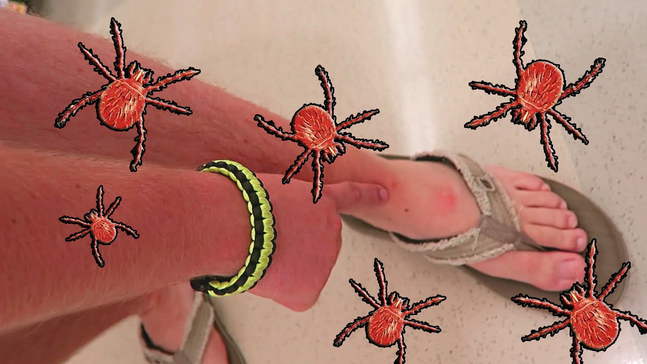 EATEN ALIVE BY CHIGGERS!!!