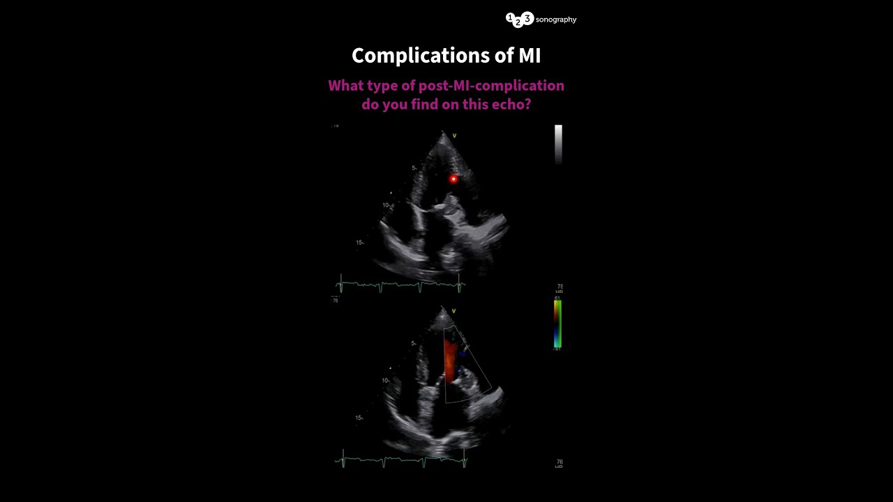 What type of post-MI-complication do you find on this echo?