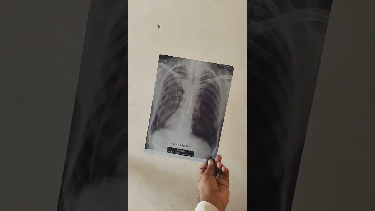 Chest X Ray on  Inkjet printer and Film Results #doctor #medical #alliedhealth #diploma #xray