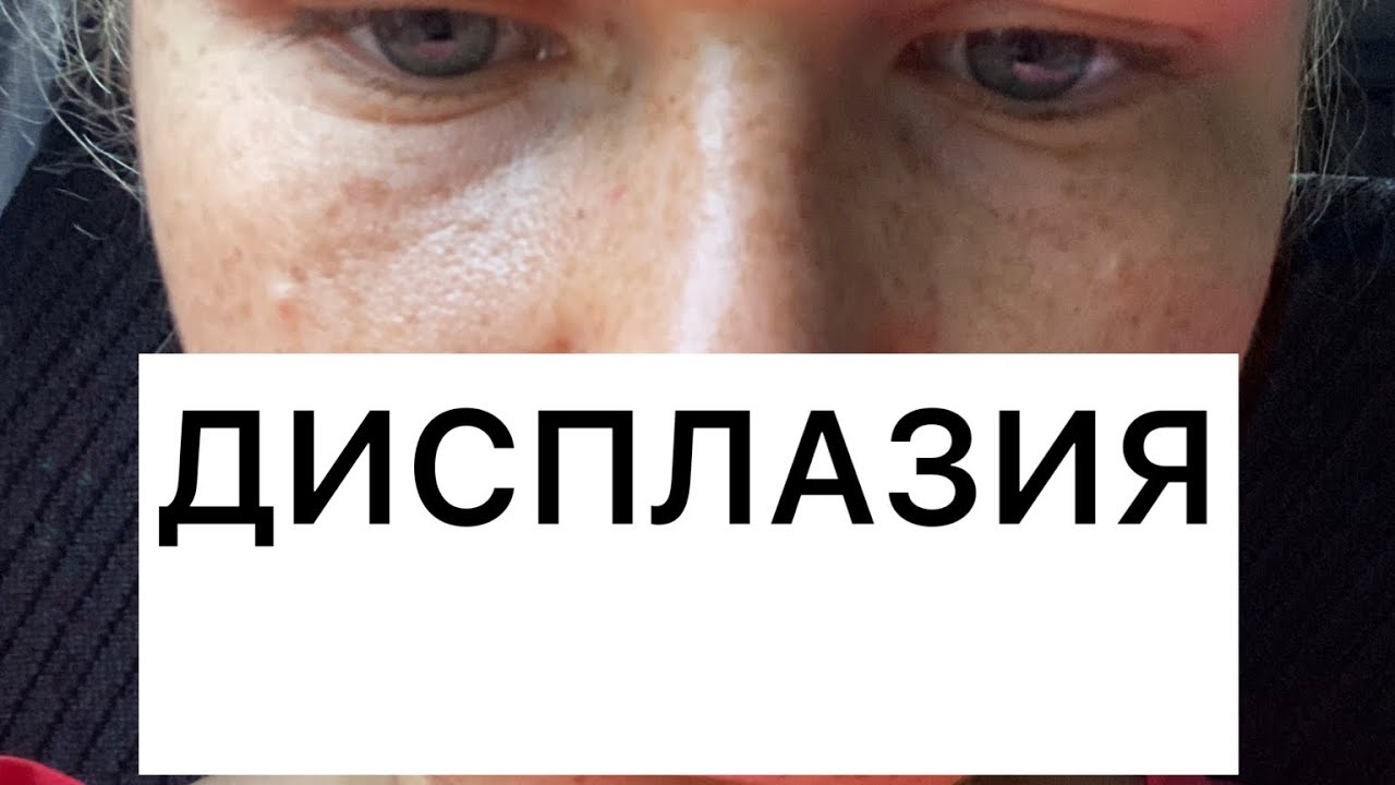 Дисплазия соединительной ткани