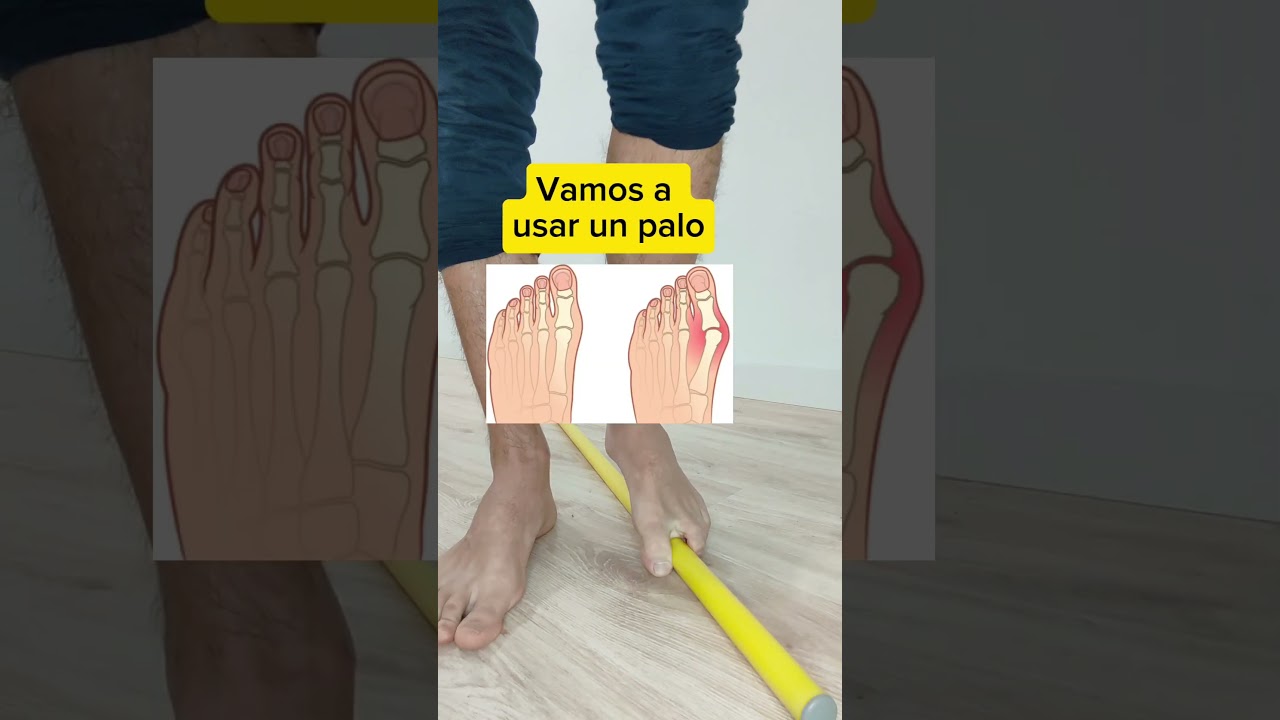 &hearts;️2 Ejercicios sencillos para HALLUX VALGUS o JUANETE #fisio #pie #purafisioterapia #juanete