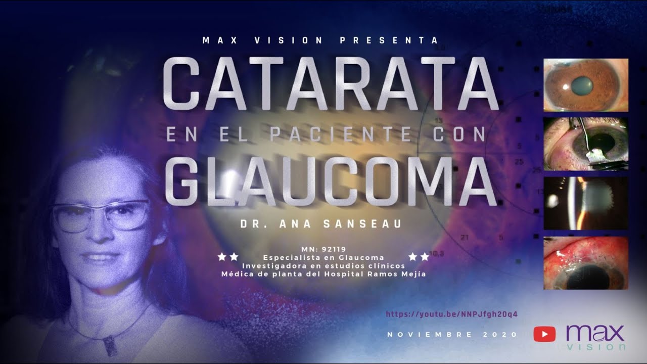 Catarata en el paciente con Glaucoma - Dra. Ana Sanseau