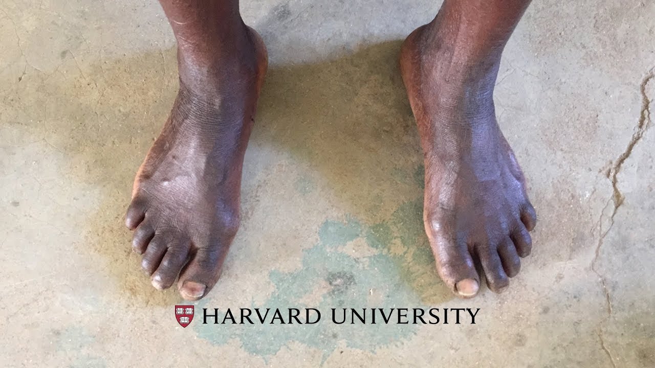 Barefoot walking