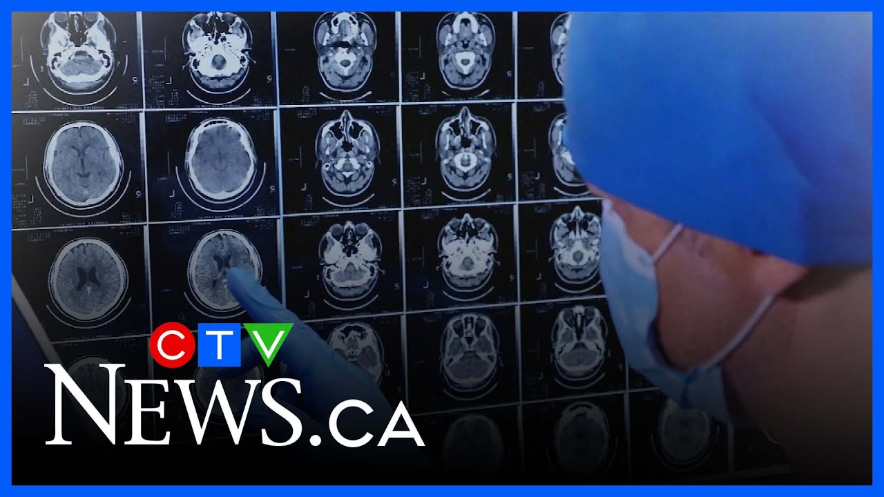 First Canadian receives promising new Alzheimer&rsquo;s drug amid coverage concerns