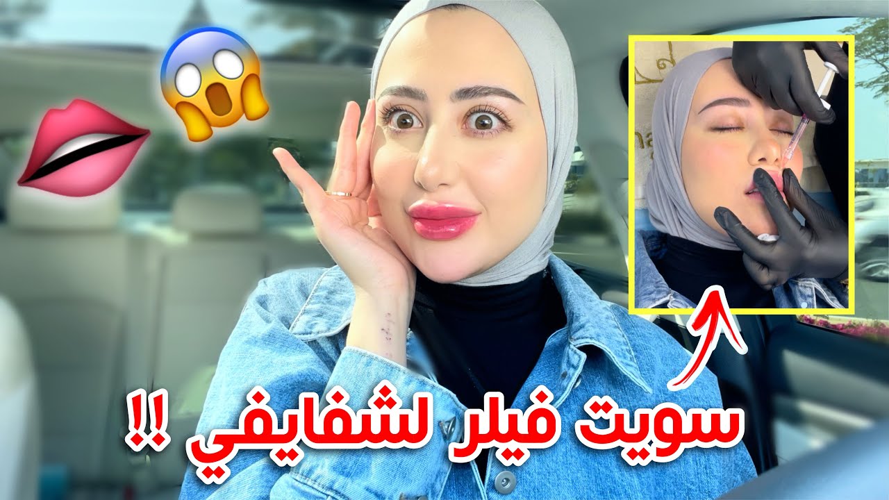 سويت فيلر لشفايفي و ذقني !! شوفوا النتيجه النهائيه 😱