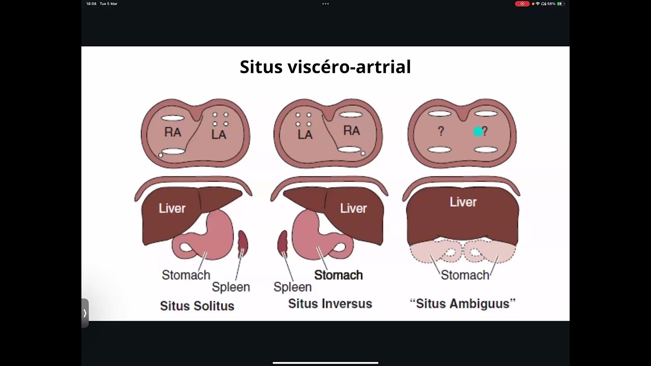 CSC-Webinar 008 : Single ventricule : Les Ventricules uniques