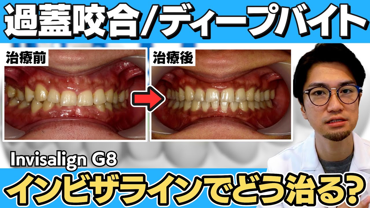 インビザラインの進化〜深い噛み合わせ編〜