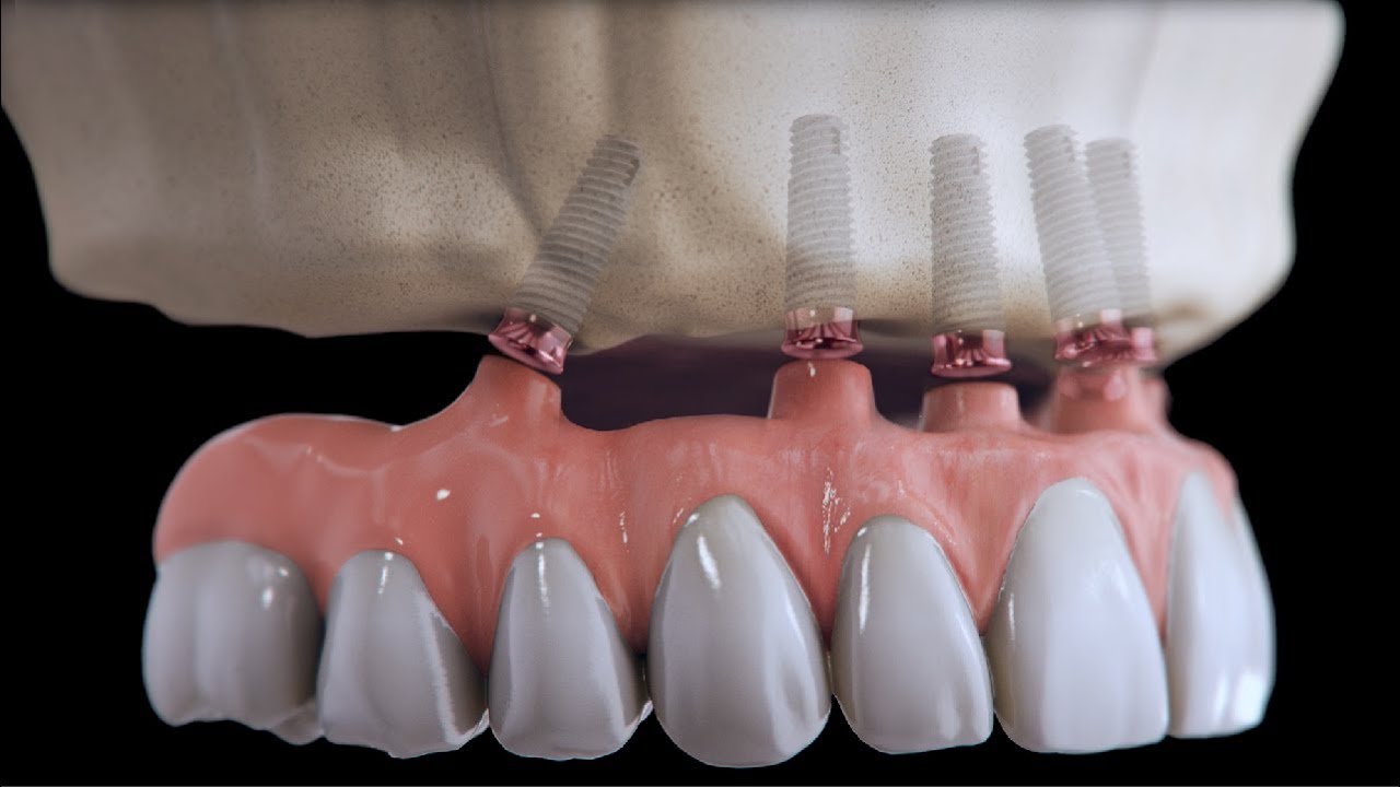 matrix® ProFlex