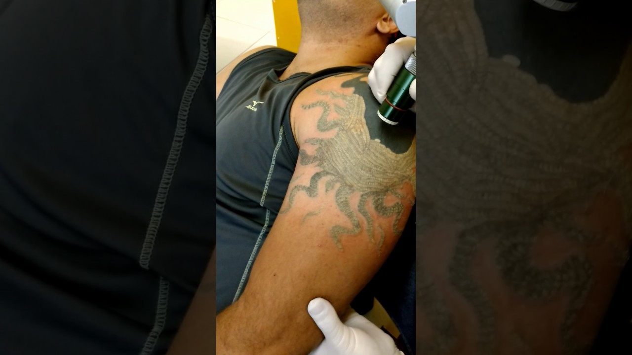 Remoção de Tatuagem em São Paulo