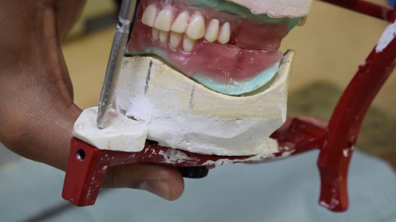 Complete denture technonolgy 2(  Posterior teeth setting)