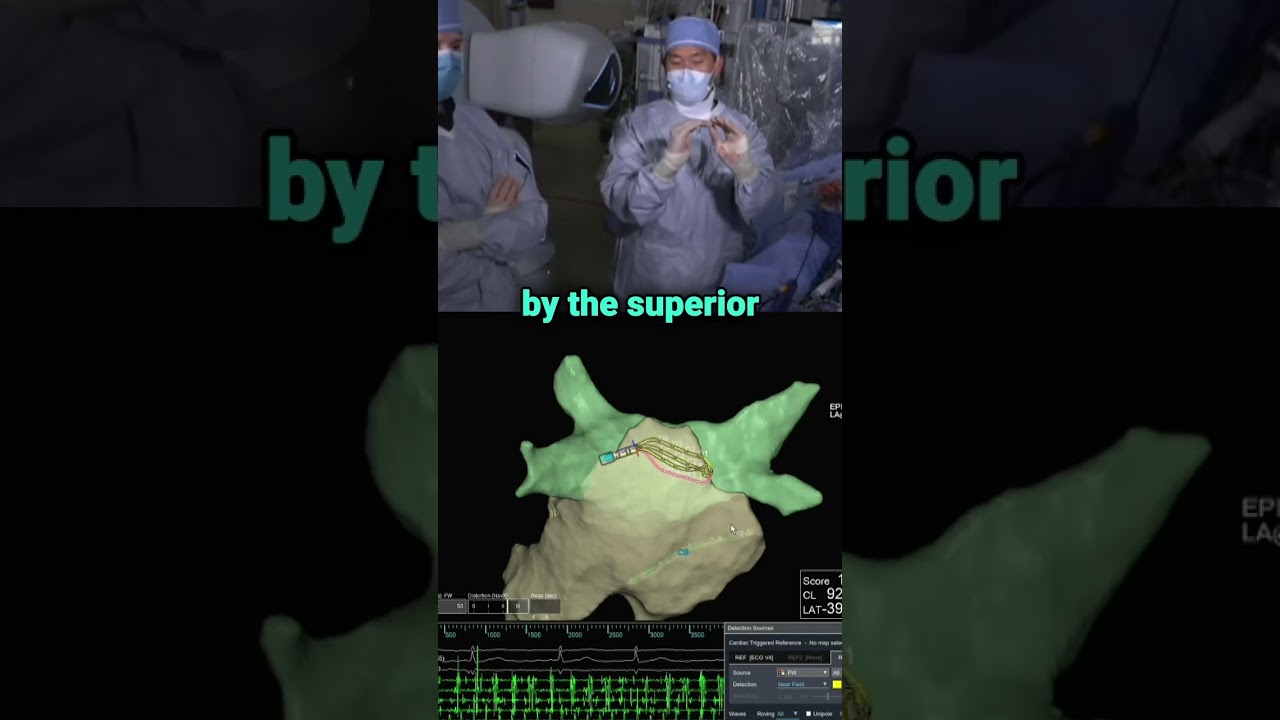 Roderick Tung performs Epicardial Mapping of Pulsed Field Endocardial Ablation