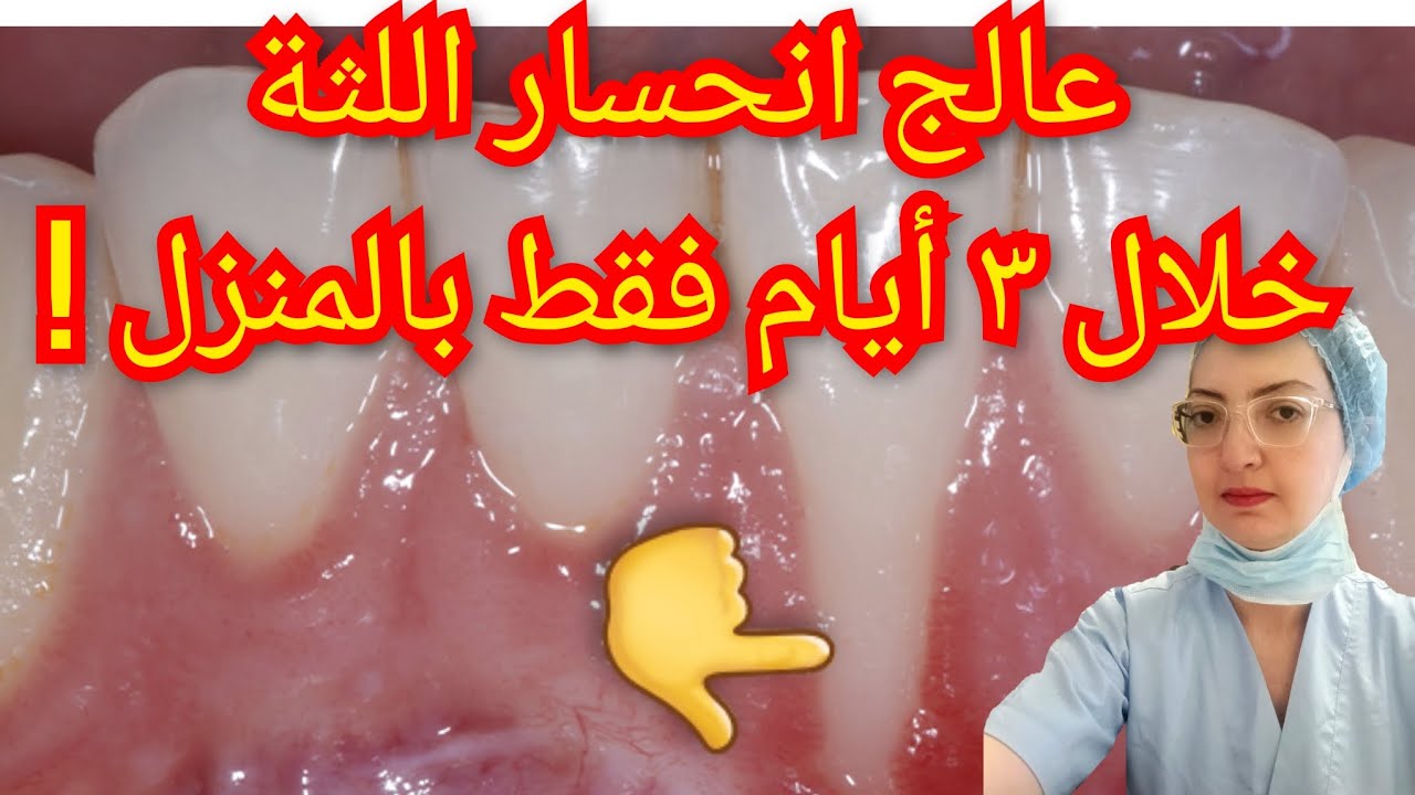 كيفية علاج تراجع و انحسار اللثة نهائياً بنفسك في المنزل بوصفة طبيعية فعالة جداً