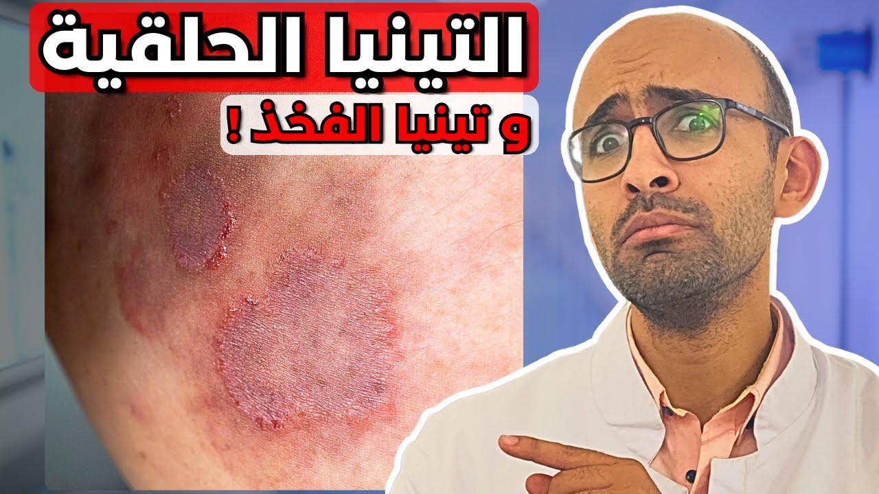 التينيا الحلقية (تينيا الفخذين) | اسبابها وعلاجها | ليه العلاج مبقاش يجيب نتيجة ؟!