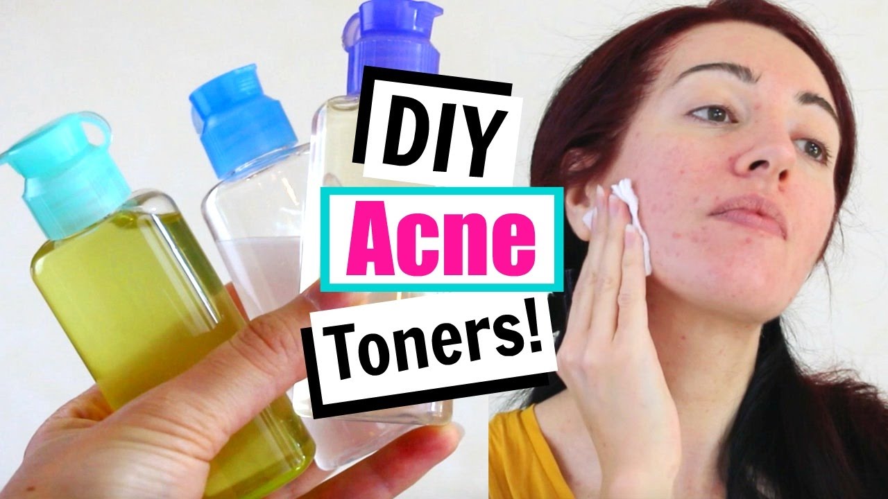 DIY Toner For Acne & Oily Skin! Home Remedies For Acne!