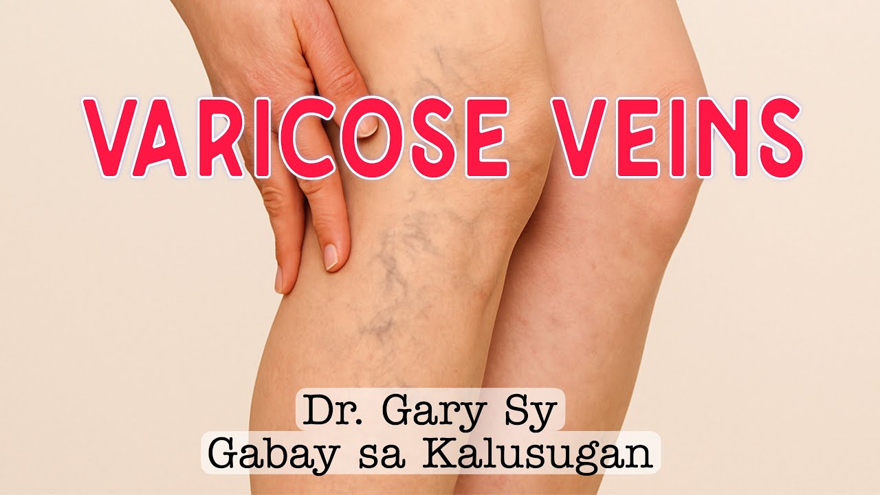 Varicose Veins - Dr. Gary Sy