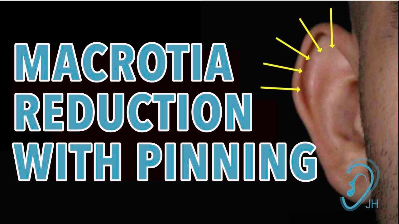 Pinning Effect of Macrotia Ear Reduction Surgery