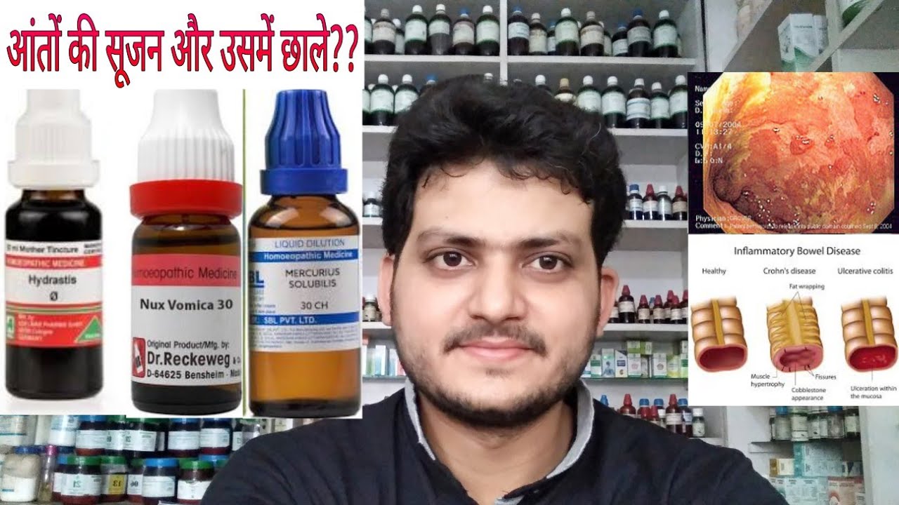 Ulcerative colitis! Homeopathic medicine for Ulcerative colitis?? explain