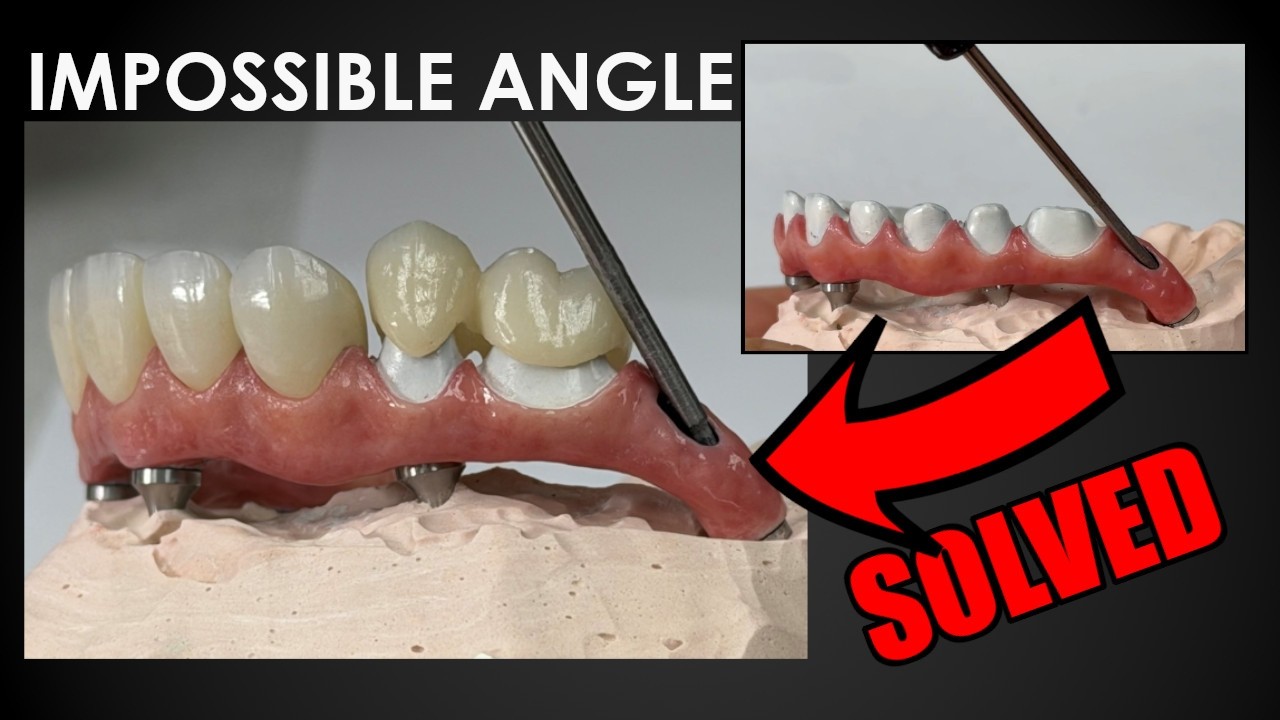 Impossible Implant Angle Solved