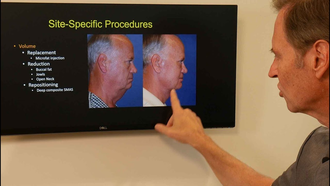 Amazing Male Facelift Results!