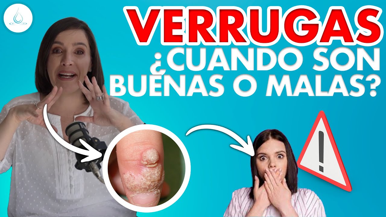 🔴 VERRUGAS ¿Que son, por que aparecen y como se tratan? @drapilarochoa - Dermatologa