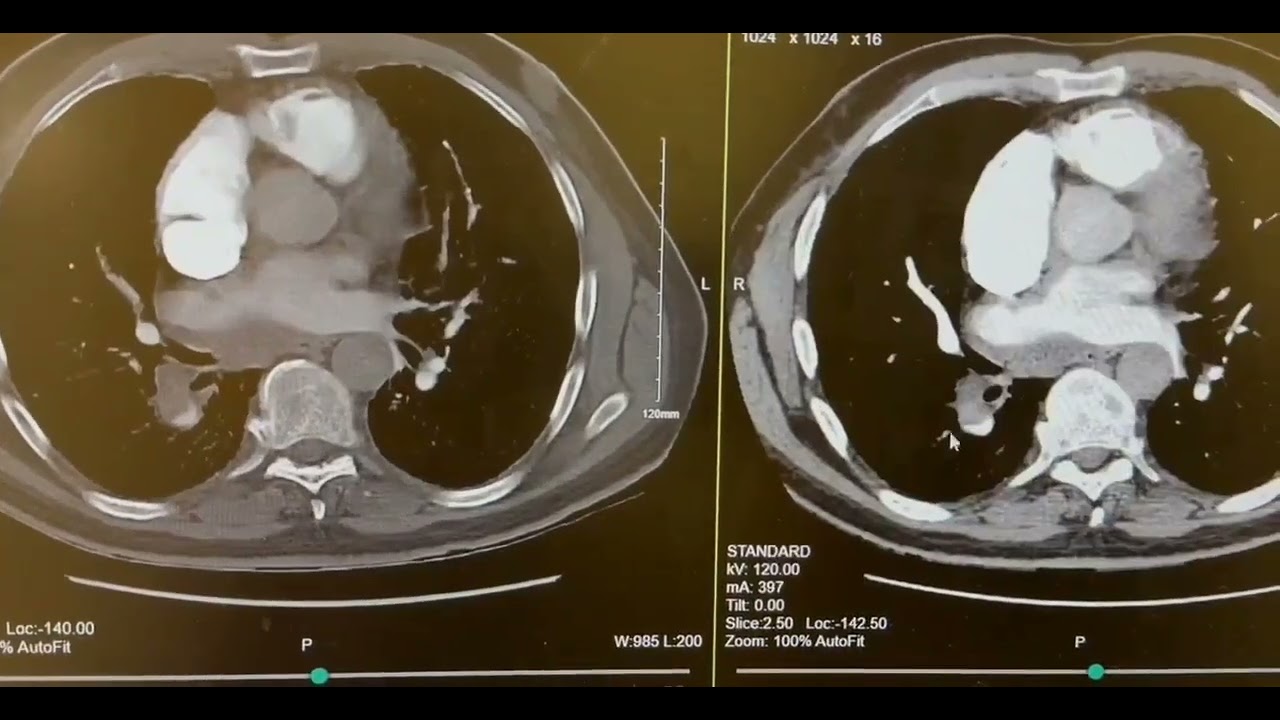 CT Angio Pulmonary Embolism WIth Contrast