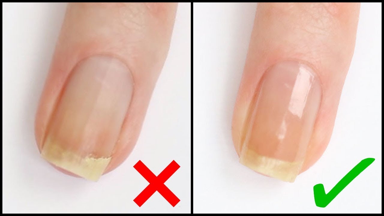 GEBROKEN NAGEL THUIS ZELF REPAREREN