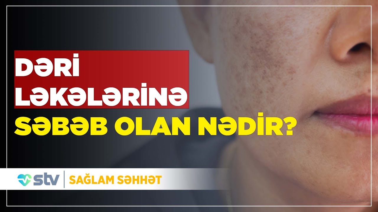 Dəridəki ləkələr hansı xəstəliyin xəbərçisidir?