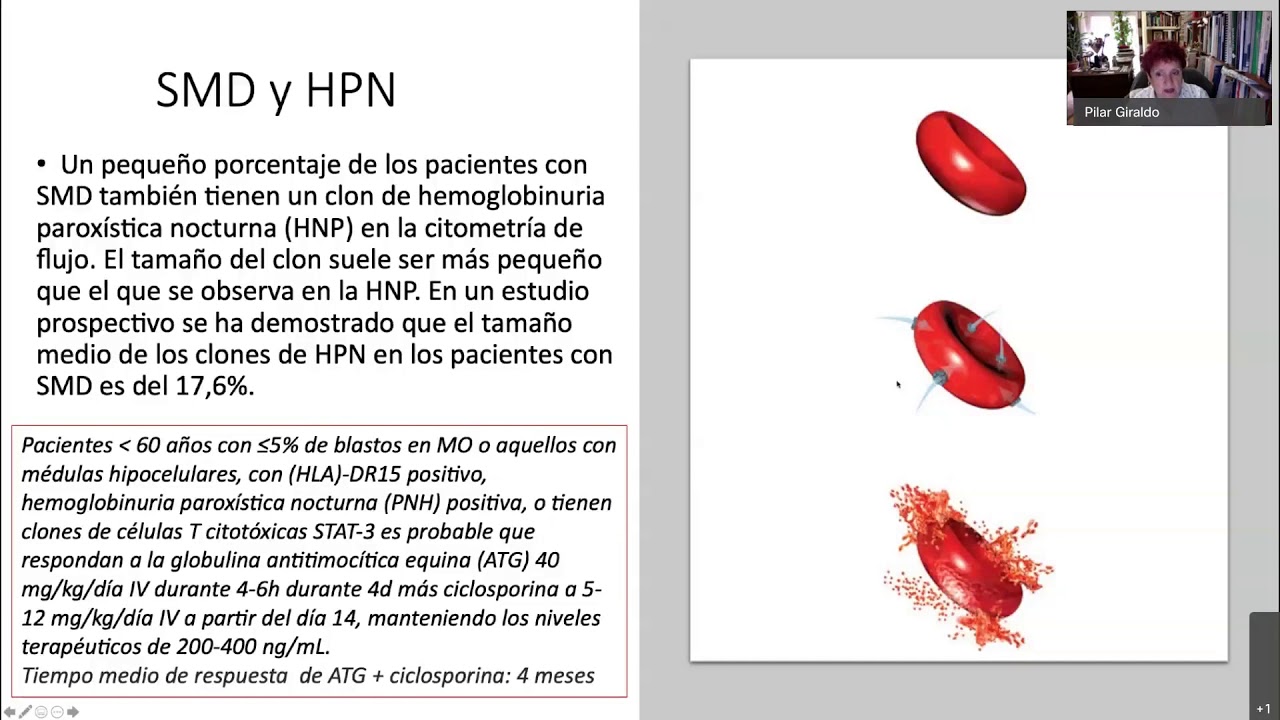 17 TALLER MIELODISPLASIA,DESDE EL PUNTO DE VISTA DEL HEMATÓLOGO Y PACIENTE. Por Pilar Giraldo.ASHPER