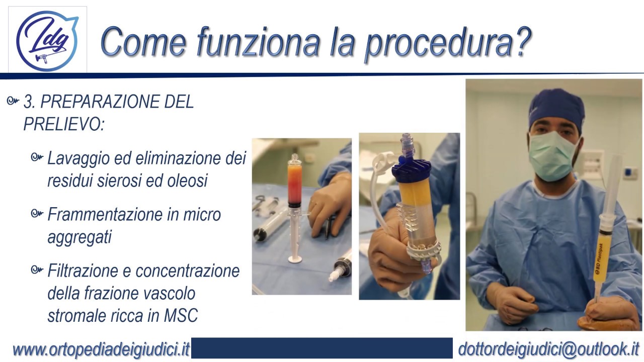 Trattamento Infiltrativo con Cellule Staminali Adipose - Dr. Luca Dei Giudici