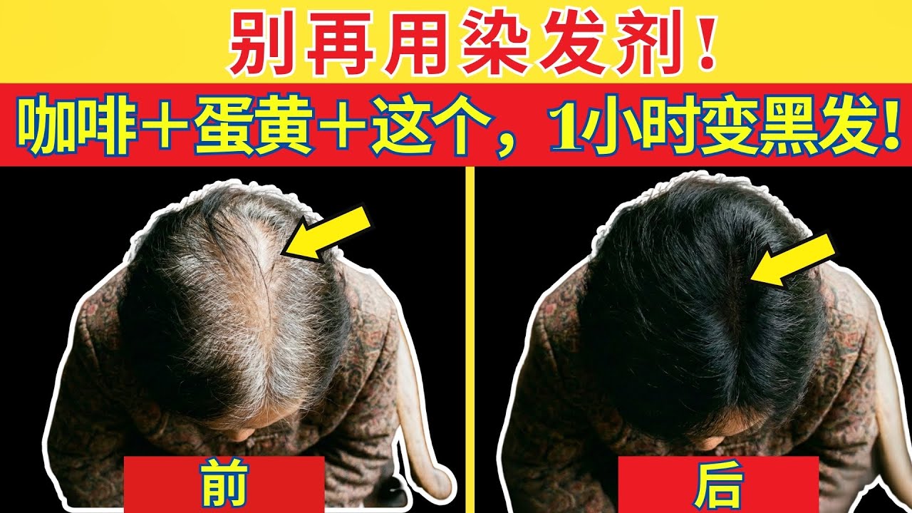 不用染发剂！咖啡加上&ldquo;这个&rdquo;，白发渐少、脱发改善？&mdash;&mdash;40年资历皮肤科医生的重要提醒｜60岁70岁必看｜银发族健康
