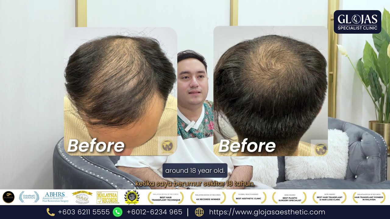 𝐇𝐚𝐢𝐫 𝐓𝐫𝐚𝐧𝐬𝐩𝐥𝐚𝐧𝐭 𝐌𝐚𝐥𝐚𝐲𝐬𝐢𝐚 | Gcell Stem Cell Therapy Client Testimonial After 5 Months