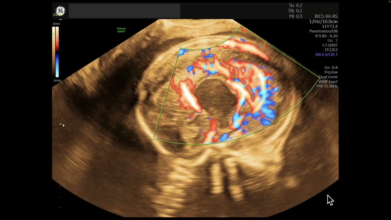 Embarazo de 20 semanas. Malformación de Dandy Walker, Agenesia de Cuerpo Calloso y Ventriculomegalia
