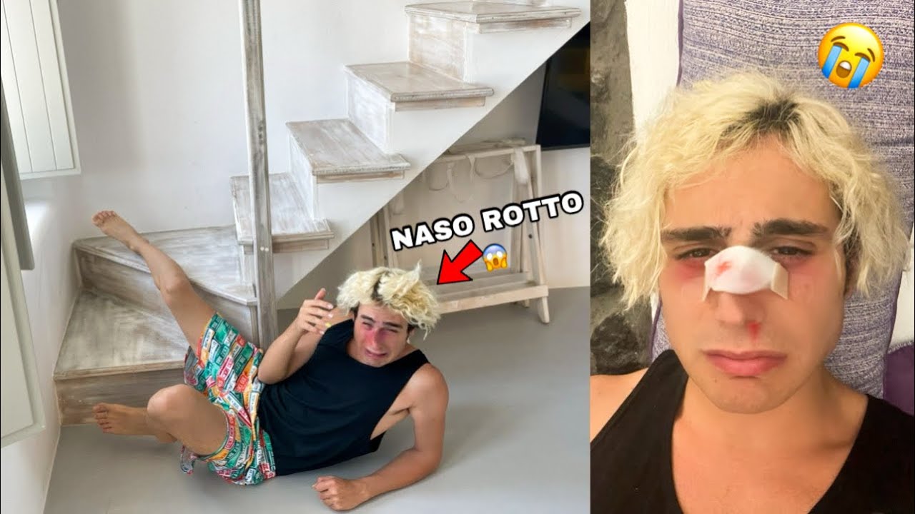 ANTO È CADUTO DALLE SCALE IN VACANZA! SI È ROTTO IL NASO!! *primo giorno di vacanza*