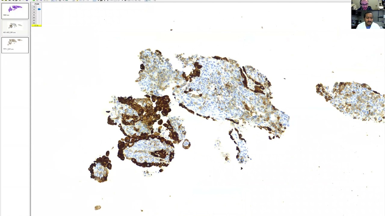 Preview of our Thoracic Pathology Survival Guide: Sclerosing Pneumocytoma in a Small Lung Biopsy