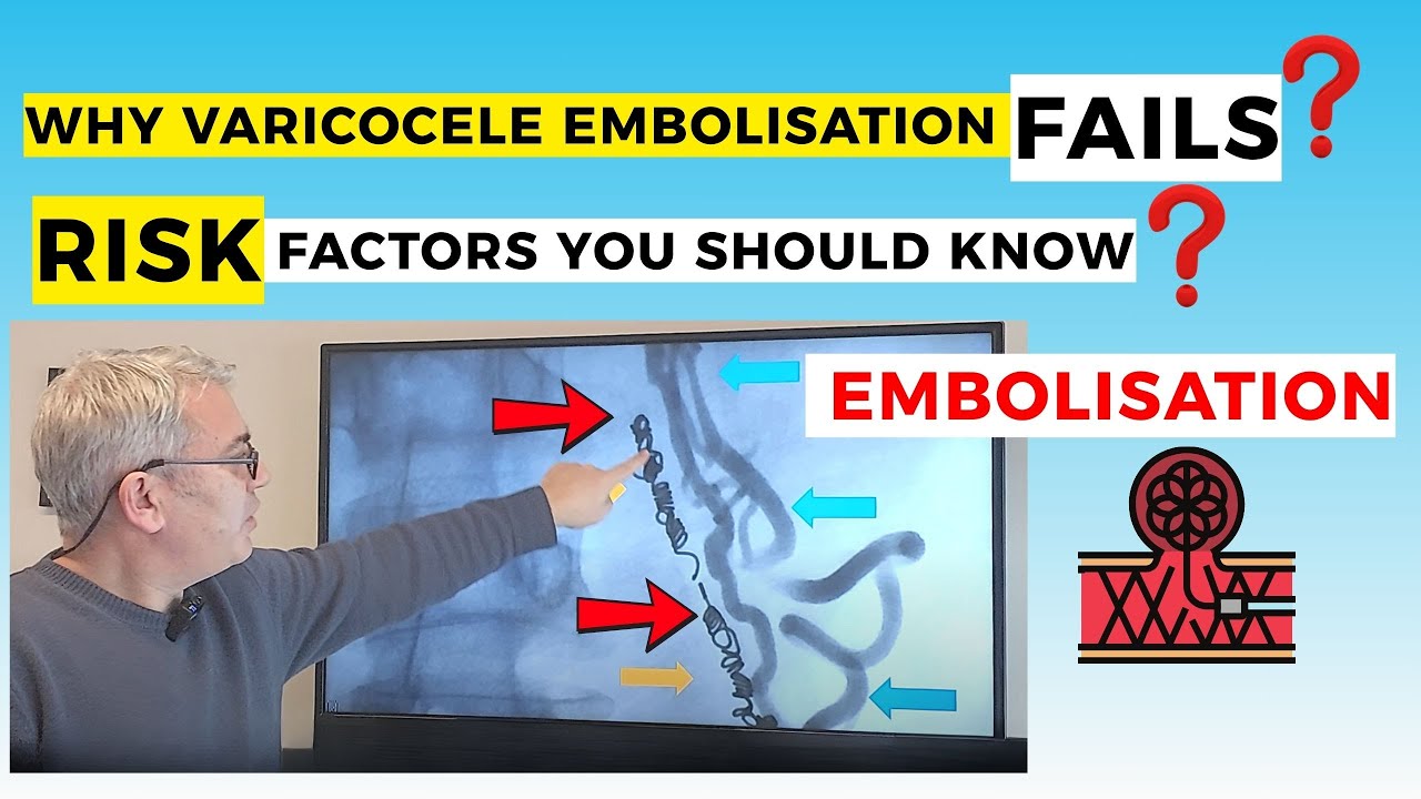 Varicocele Embolisation Failure: What Are the Possible Risk Factors? #Embolisation