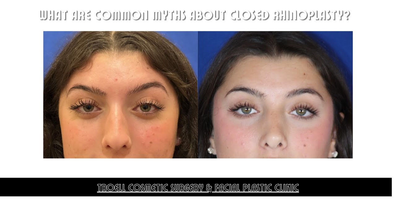 Myths about Rhinoplasty in Las Vegas NV - Troell Cosmetic Surgery & Facial Plastic Clinic