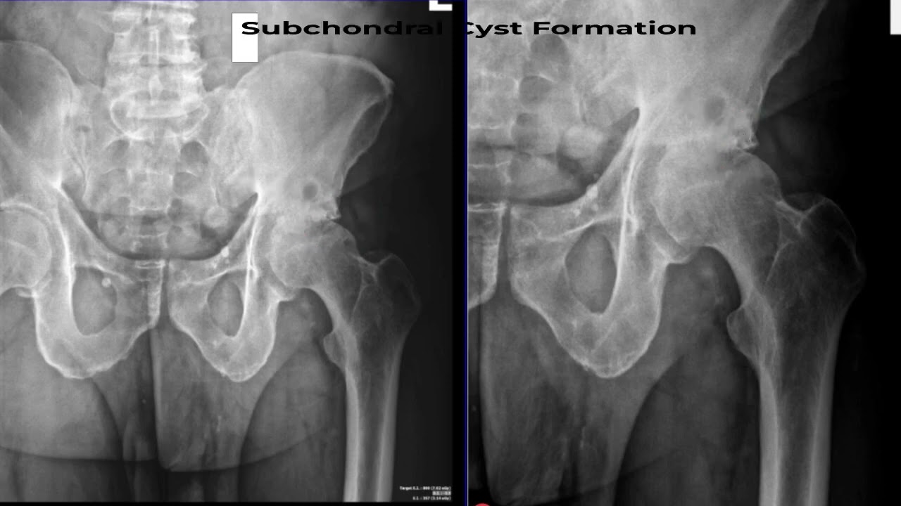Dr Germanuel Landfair Explains A Hip X Ray