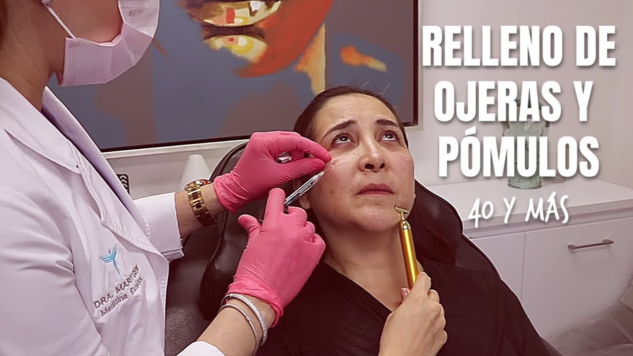 Relleno de Ojeras y Pómulos con ácido hialurónico | Mujeres de 40 años y más