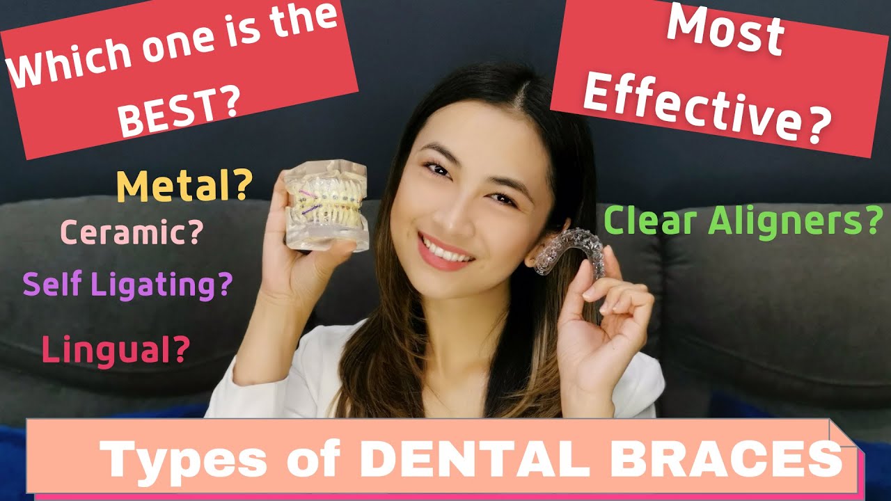 Which type of DENTAL BRACES is the BEST for you? Most effective?🇵🇭🇵🇭🇵🇭
