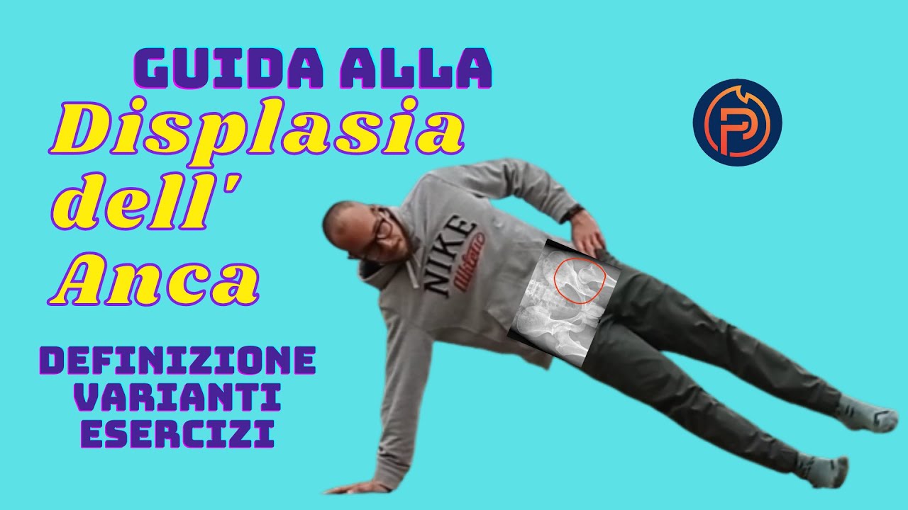 LA DISPLASIA DELL' ANCA - Displasia Acetabolare. (2022)
