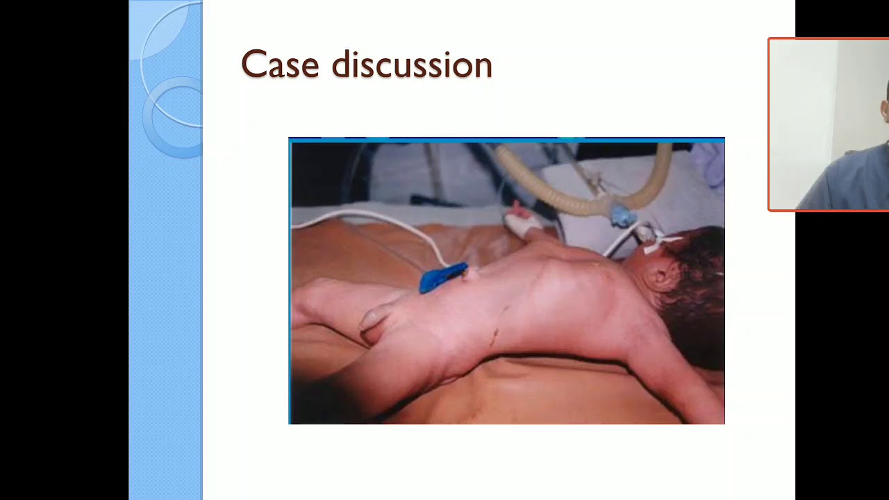 Case 2 congenital diaphragmtic hernia CDH,  respiratory distress, respiratory failure, PPHN,