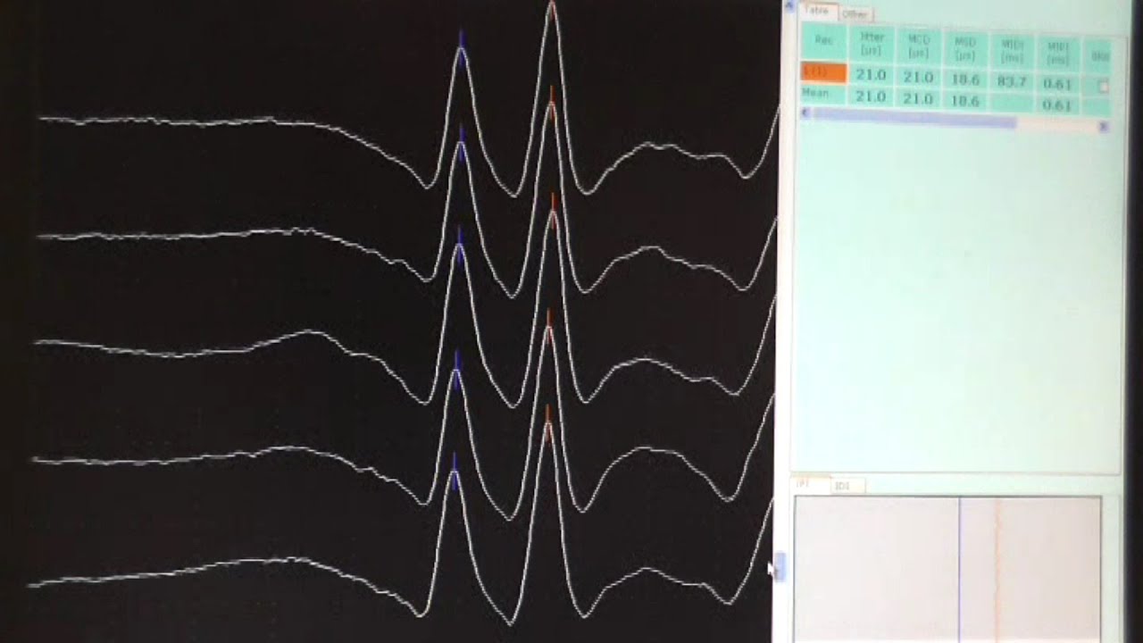 #Neuromuscular #junction tests (#Repetitive #Nerve #Stimulation and #Single #Fibre EMG)