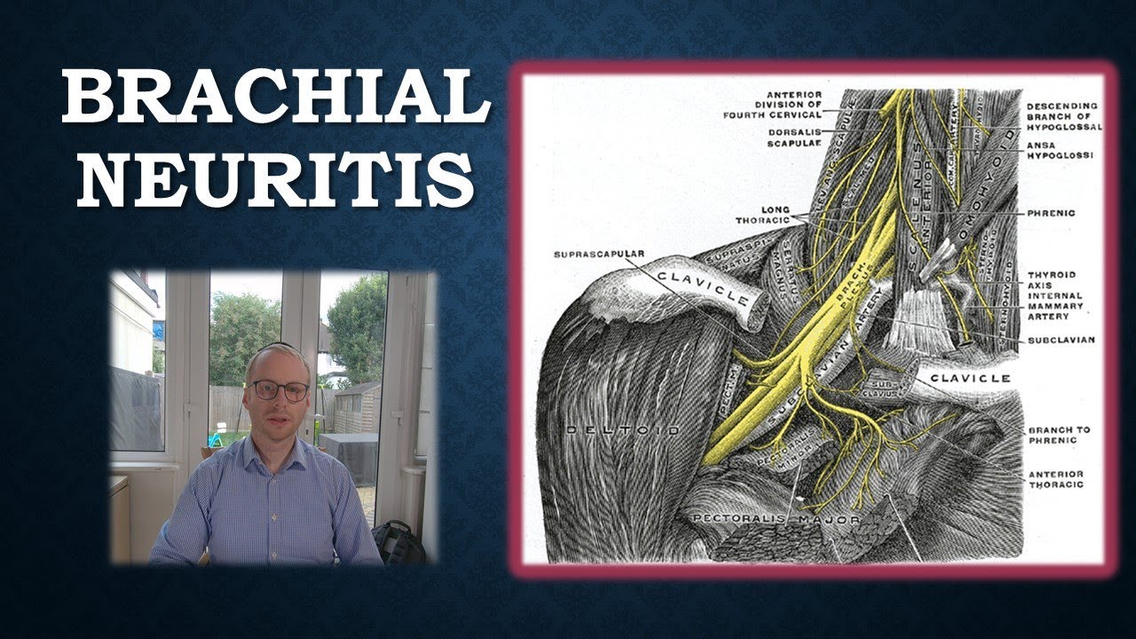 Brachial Neuritis / Parsonage Turner Syndrome