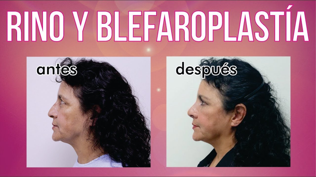 RINO Y BLEFAROPLASTÍA ❤️ CAMBIO EXTREMO!!! DR. ALBERTO CALVO QUIROZ