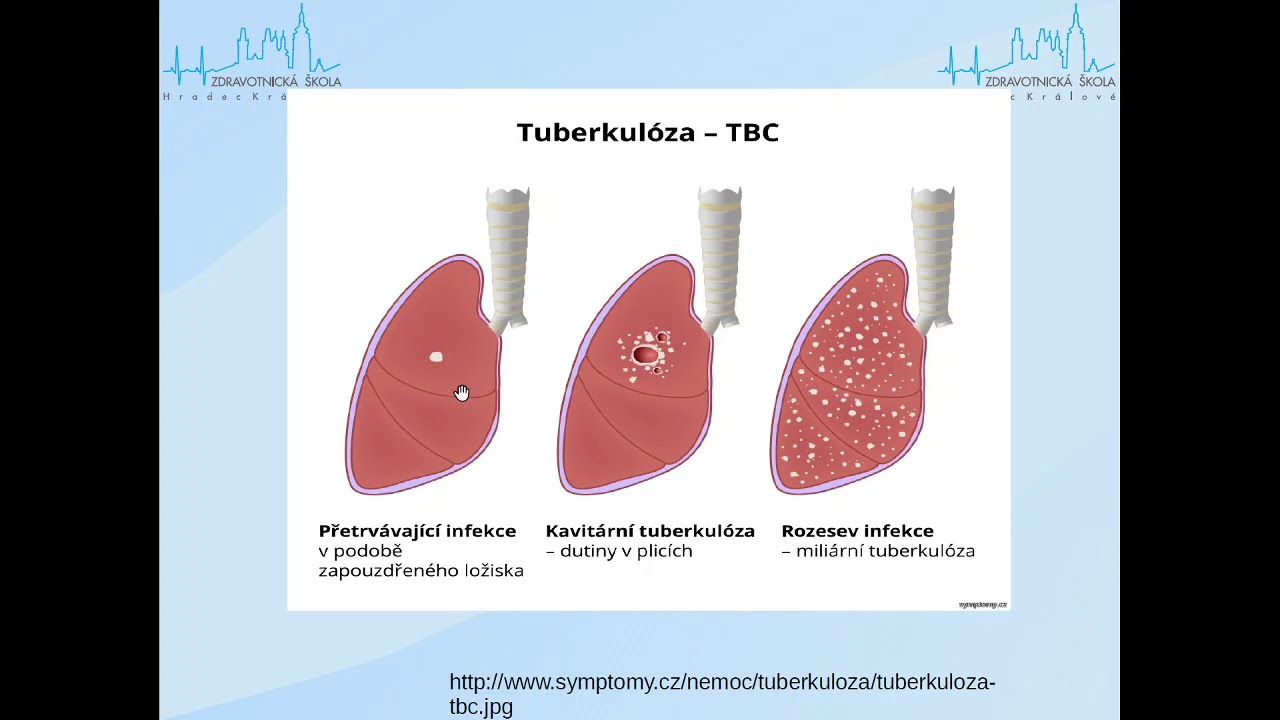 Tuberkulóza