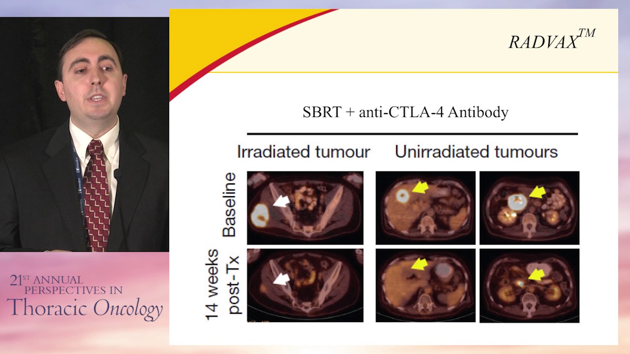Debate: Surgery versus stereotactic body radiation therapy in early stage NSCLC - SBRT