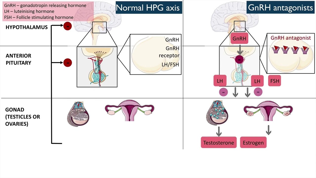 Gonadotropin-releasing hormone (GnRH) antagonists